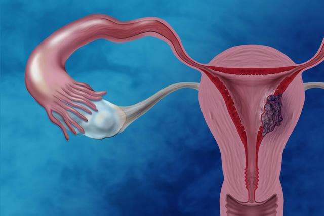 <a href='https://www.haoeyou.com/ovariancancer/' target='_blank'><u>卵巢癌</u></a> (7).jpg