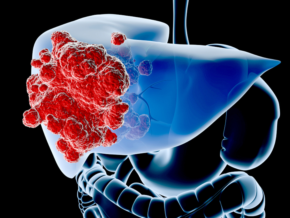 <a href='https://www.haoeyou.com/livercancer/' target='_blank'><u>肝癌</u></a>3).jpg