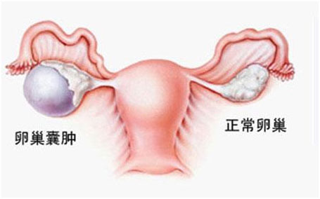 卵巢囊肿