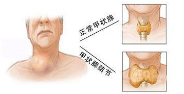 甲状腺结节