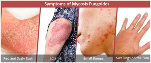 蕈样真菌病(mycosis fugoides, MF),蕈样肉芽肿