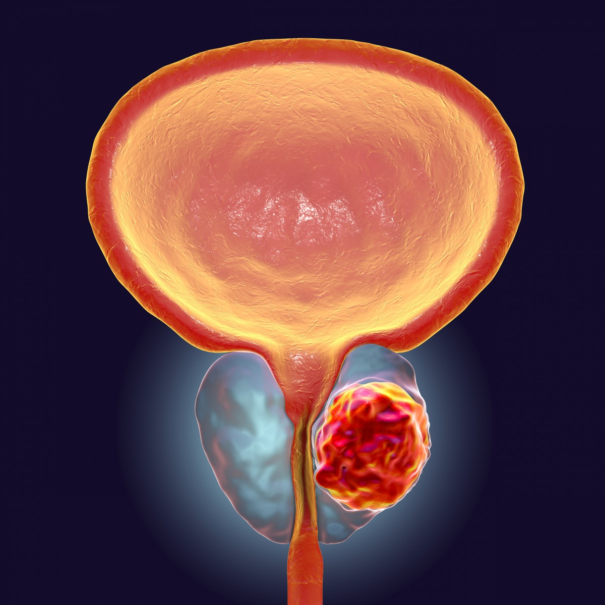 <a href='https://www.haoeyou.com/prostaticcancer/' target='_blank'><u>前列腺癌</u></a>zx.jpg
