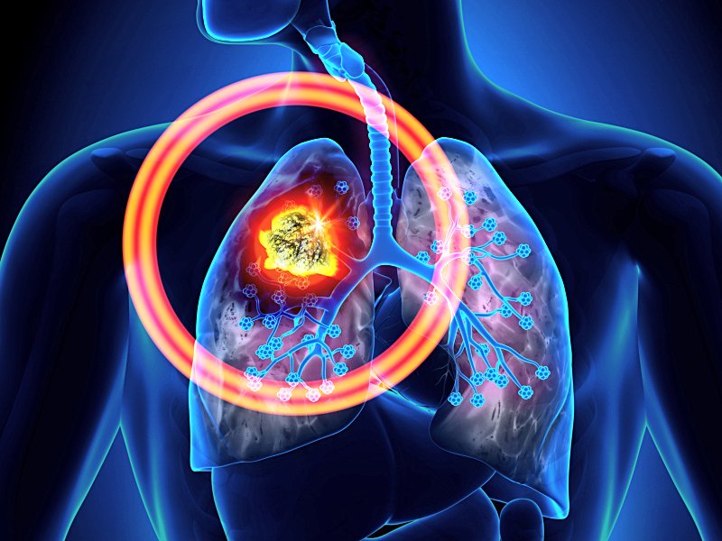 <a href='https://www.haoeyou.com/lungcancer/' target='_blank'><u>肺癌</u></a> (17).jpg
