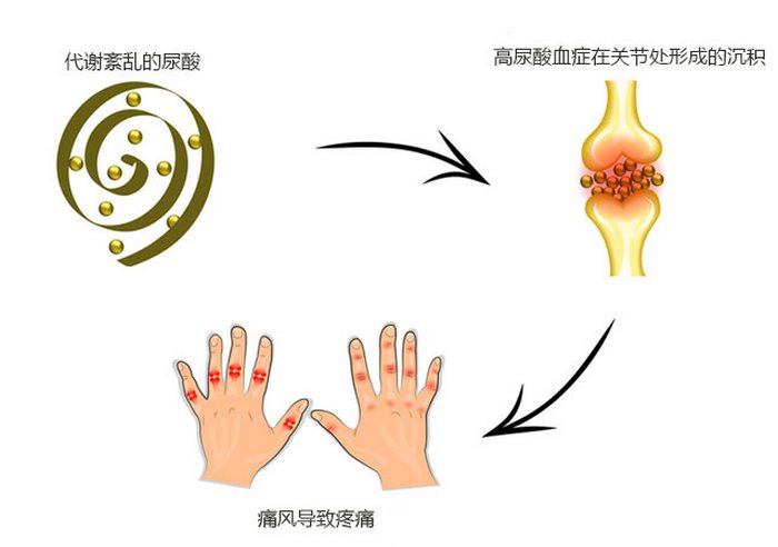痛风急性期和非急性期用药原则