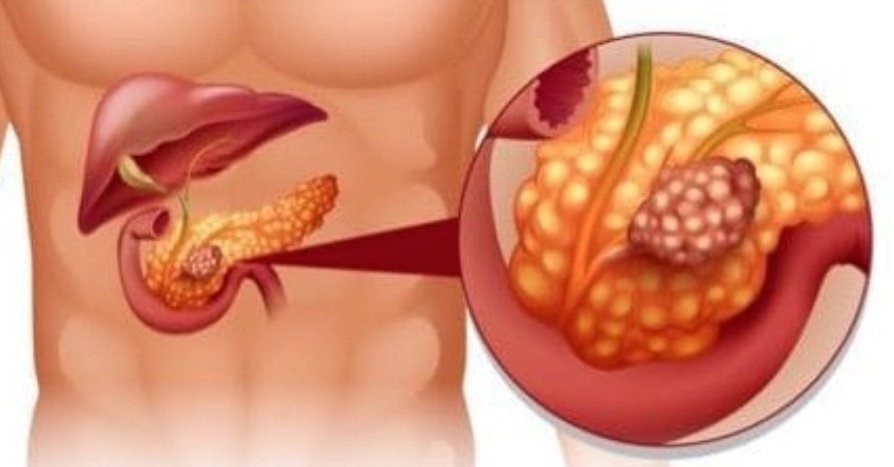 <a href='https://www.haoeyou.com/pancreaticcancer/' target='_blank'><u>胰腺癌</u></a> (5).jpg