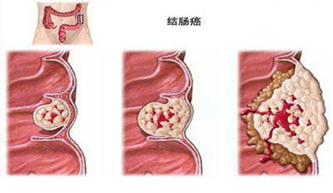 结肠癌 (1).jpg