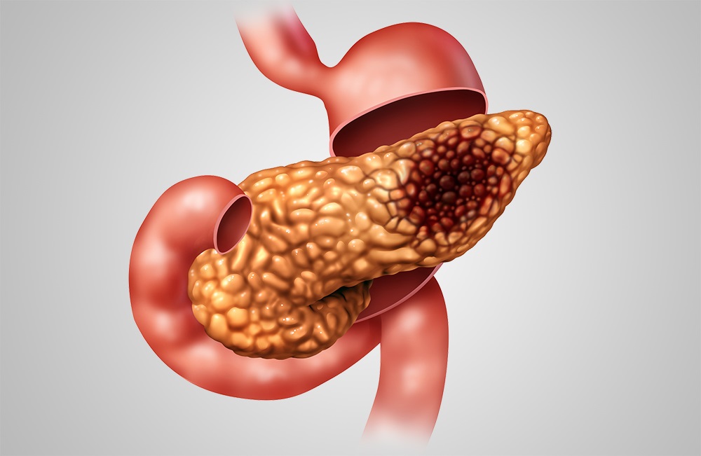 <a href='https://www.haoeyou.com/pancreaticcancer/' target='_blank'><u>胰腺癌</u></a>sas.jpg