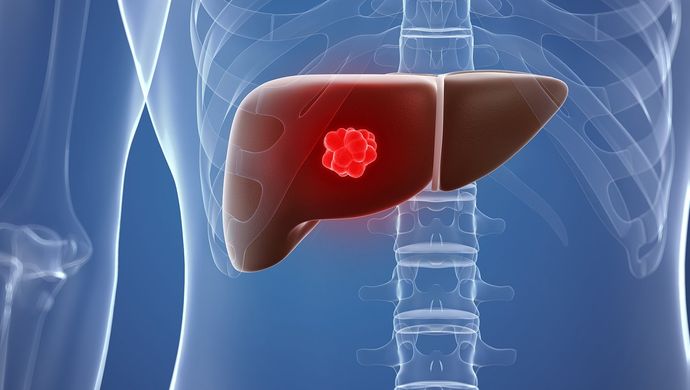 <a href='https://www.haoeyou.com/livercancer/' target='_blank'><u>肝癌</u></a>.jpg