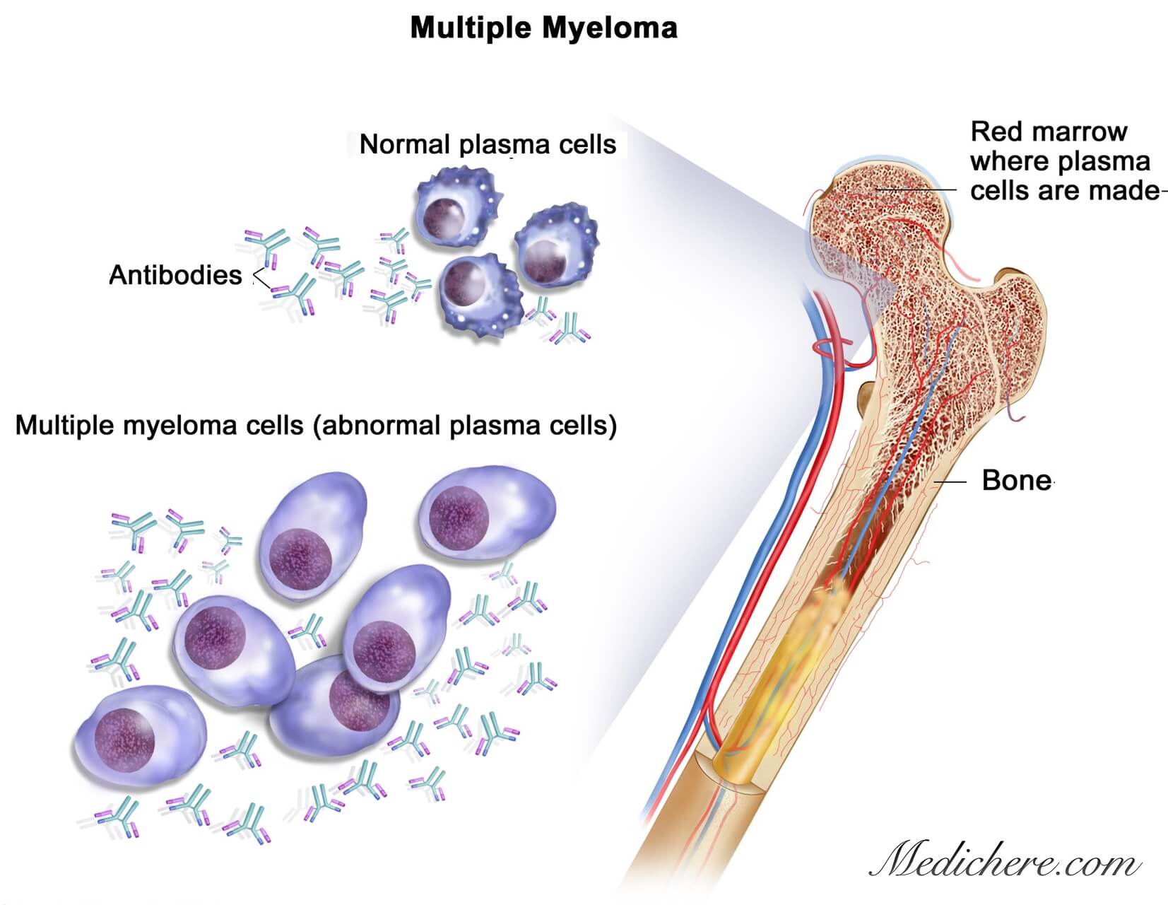 <a href='https://www.haoeyou.com/multiplemyeloma/' target='_blank'><u>多发性骨髓瘤</u></a> (12).jpg
