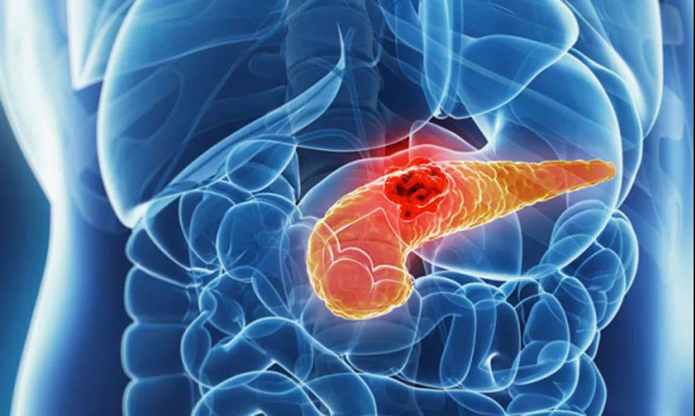 <a href='https://www.haoeyou.com/pancreaticcancer/' target='_blank'><u>胰腺癌</u></a> (3).jpg
