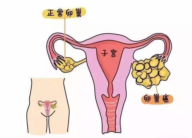 <a href='https://www.haoeyou.com/ovariancancer/' target='_blank'><u>卵巢癌</u></a> (1).jpg