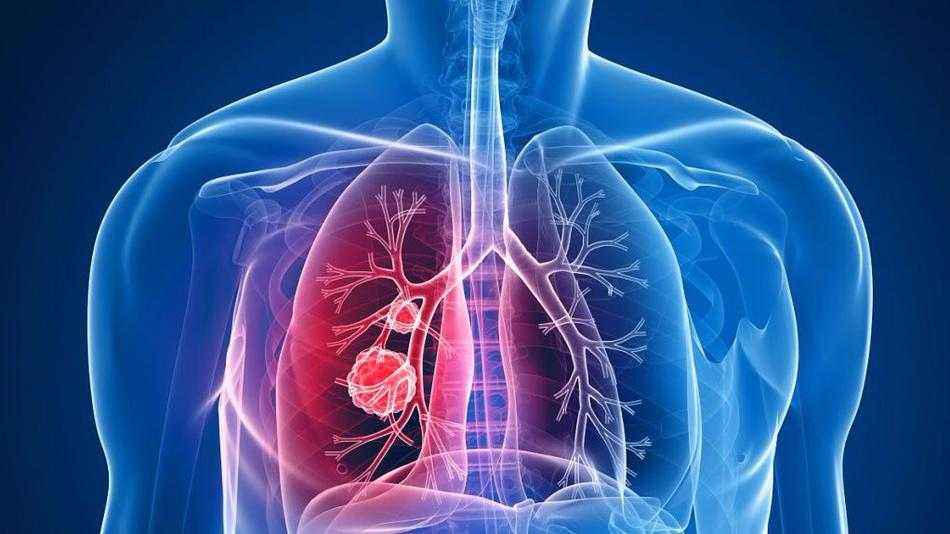 <a href='https://www.haoeyou.com/lungcancer/' target='_blank'><u>肺癌</u></a> (2).jpg