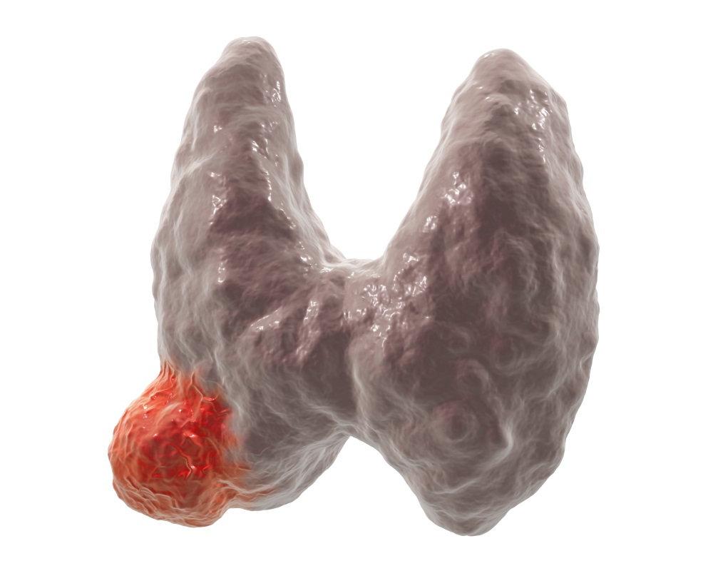 甲状腺癌 (12).jpg
