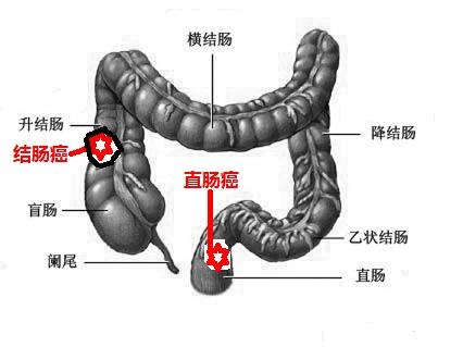 <a href='https://www.haoeyou.com/colorectalcancer/' target='_blank'><u>结直<a href='http://zhannei.baidu.com/cse/search?s=3220316627732063245&en' target='_blank'><u>肠癌</u></a></u></a> (3).jpg