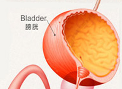 <a href='https://www.haoeyou.com/bangguangai/' target='_blank'><u>膀胱癌</u></a> (1).jpg