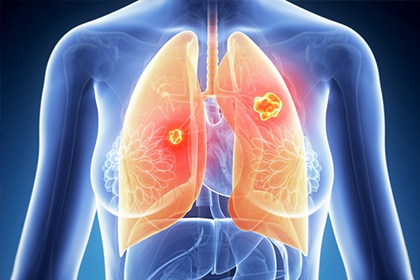 <a href='https://www.haoeyou.com/lungcancer/' target='_blank'><u>肺癌</u></a>1.jpg