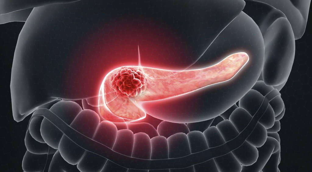 <a href='https://www.haoeyou.com/pancreaticcancer/' target='_blank'><u>胰腺癌</u></a> (10).jpg