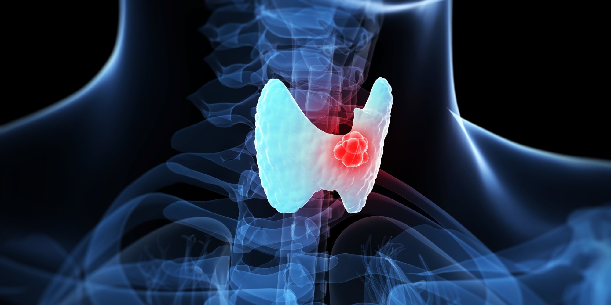 甲状腺癌 (13).jpg