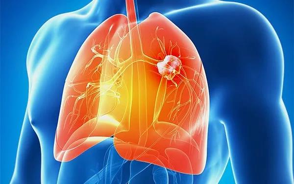 <a href='https://www.haoeyou.com/lungcancer/' target='_blank'><u>肺癌</u></a>w9.jpg