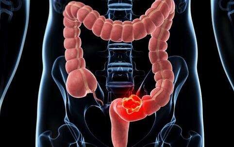 <a href='https://www.haoeyou.com/colorectalcancer/' target='_blank'><u>结直<a href='http://zhannei.baidu.com/cse/search?s=3220316627732063245&en' target='_blank'><u>肠癌</u></a></u></a> (12).jpg