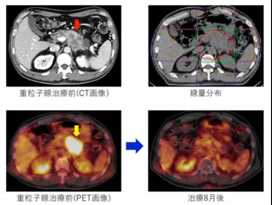 0817重离子治疗胰腺癌效果显著.jpg