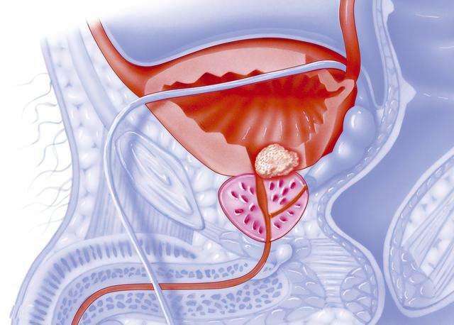 <a href='https://www.haoeyou.com/prostaticcancer/' target='_blank'><u>前列腺癌</u></a>3.jpg