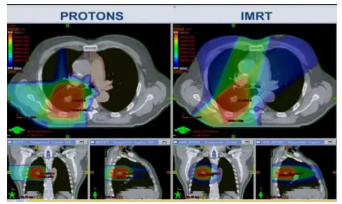 0824中央型<a href='https://www.haoeyou.com/lungcancer/' target='_blank'><u>肺癌</u></a>质子治疗.png