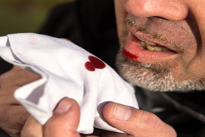Hemoptysis.jpg
