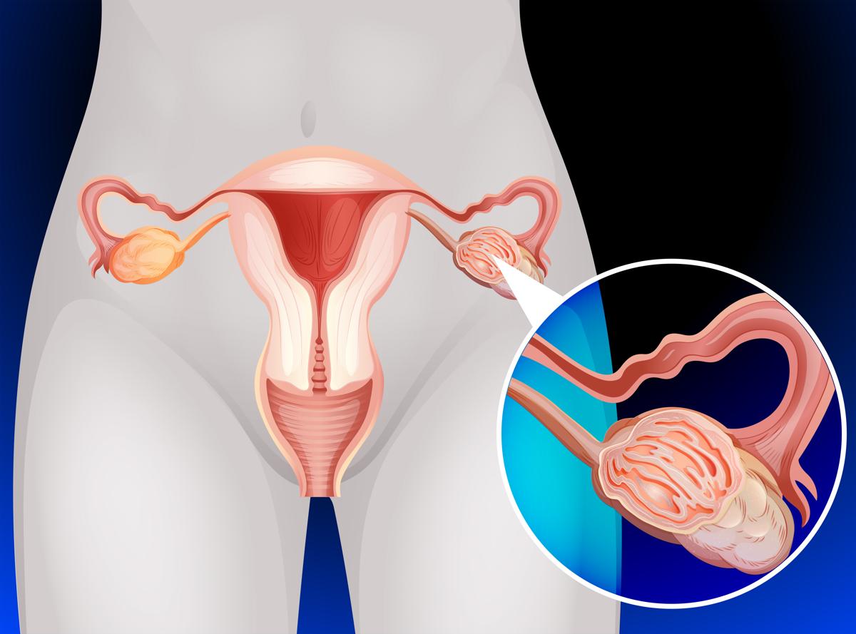 <a href='https://www.haoeyou.com/ovariancancer/' target='_blank'><u>卵巢癌</u></a>3.jpg