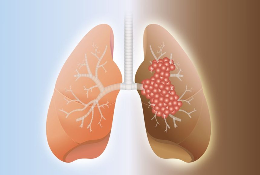 肺癌 (15).jpg
