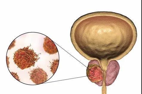 前列腺癌 (2).jpg