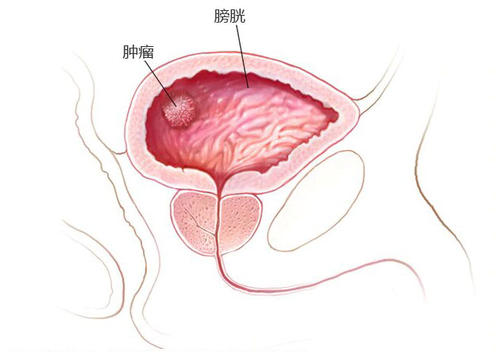 膀胱癌9.jpg