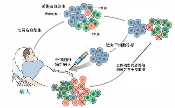 白血病干细胞移植1.jpg