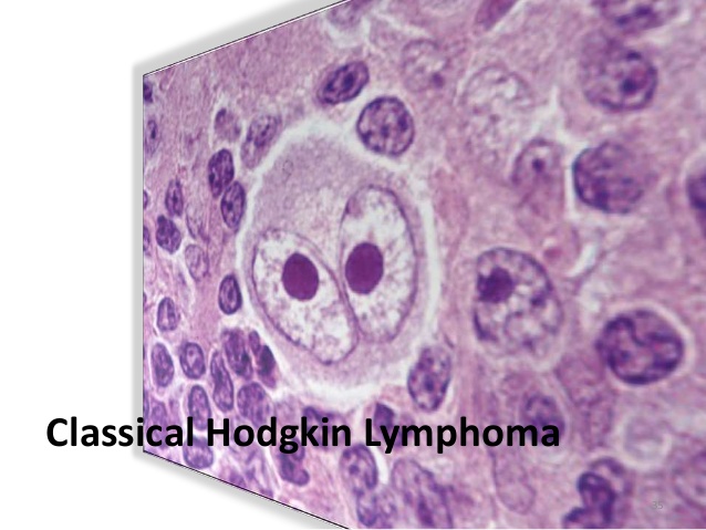 淋巴瘤经典型霍奇金3.jpg