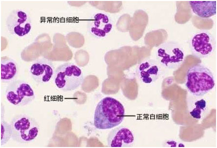 白血病，慢性粒细胞性白血病