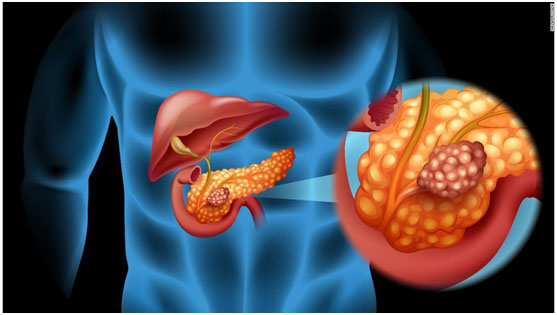 美国精准医疗肿瘤专家远程会诊胰腺癌患者