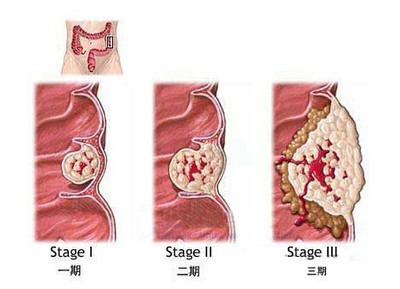 结肠癌早期的5大症状图片