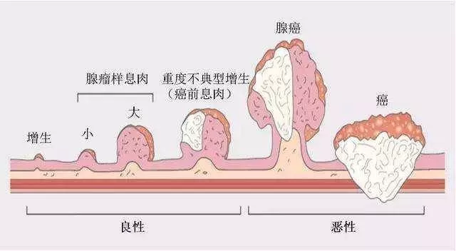 息肉3.jpg