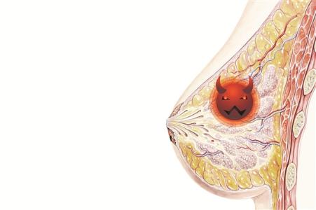 乳腺癌41.jpg