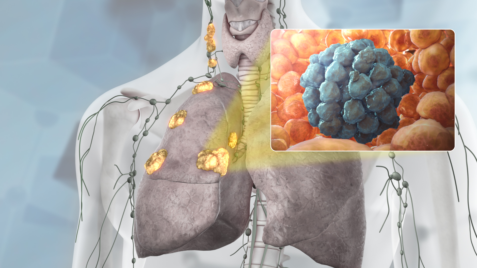 NormalLungsVsAffectedLungs.jpg