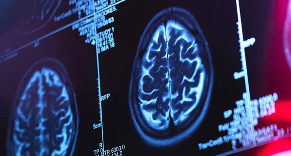 mri-brain-scan_1024.webp.jpg