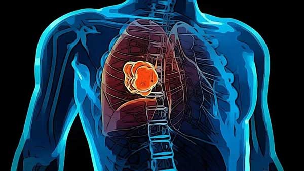 免疫疗法舒格利单抗，治疗肺癌：死亡风险降低52%！